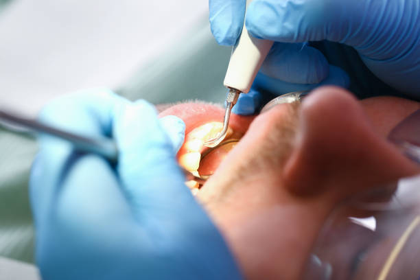 Best Emergency Treatment for Dental Infections or Abscesses in Coupeville, WA