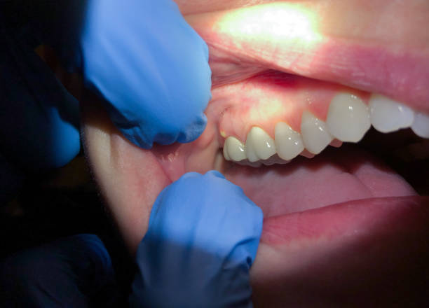 Best Emergency Dental Care for Broken or Chipped Teeth in Coupeville, WA